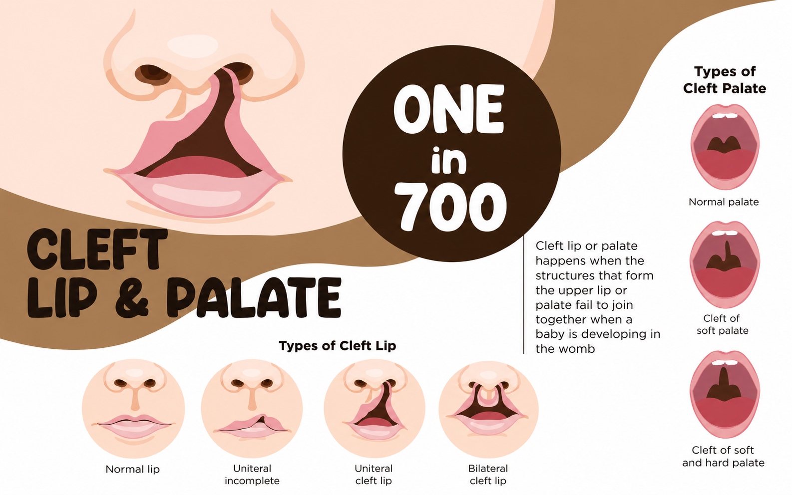 Cleft lip and palate correction – specialist dentist Hyderabad
